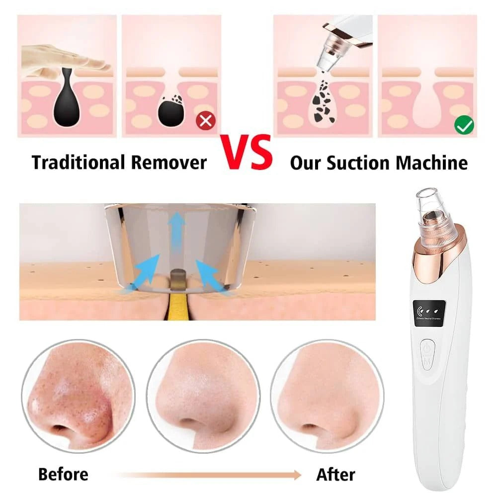 Professional Blackhead Remover Vacuum – Deep Cleansing Pore Cleaner | 5 Heads Acne Suction Device for Face Care