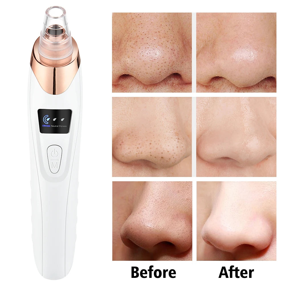 Professional Blackhead Remover Vacuum – Deep Cleansing Pore Cleaner | 5 Heads Acne Suction Device for Face Care